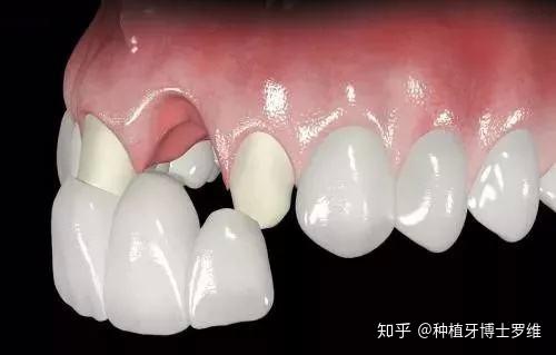 最新活动假牙，一口新牙，一个全新的人生